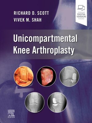 cover image of Unicompartmental Knee Arthroplasty, E-Book